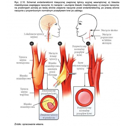 produkt - Jakość życia chorych po rewaskularyzacji krytycznego zwężenia tętnicy szyjnej wewnętrznej